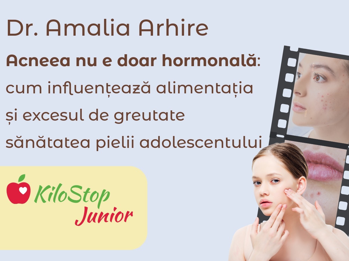 Acneea la adolescenți: cum influențează alimentația și excesul de greutate sănătatea pielii